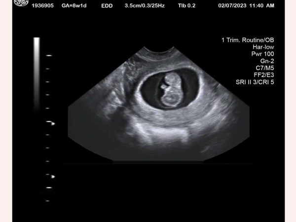 9 Week Ultrasound