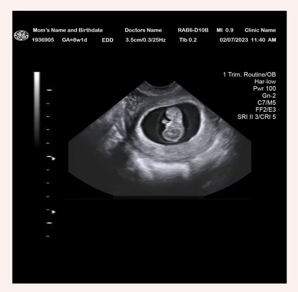 9 Week Ultrasound Ultrasounds 9 Week Ultrasound Ultrasounds