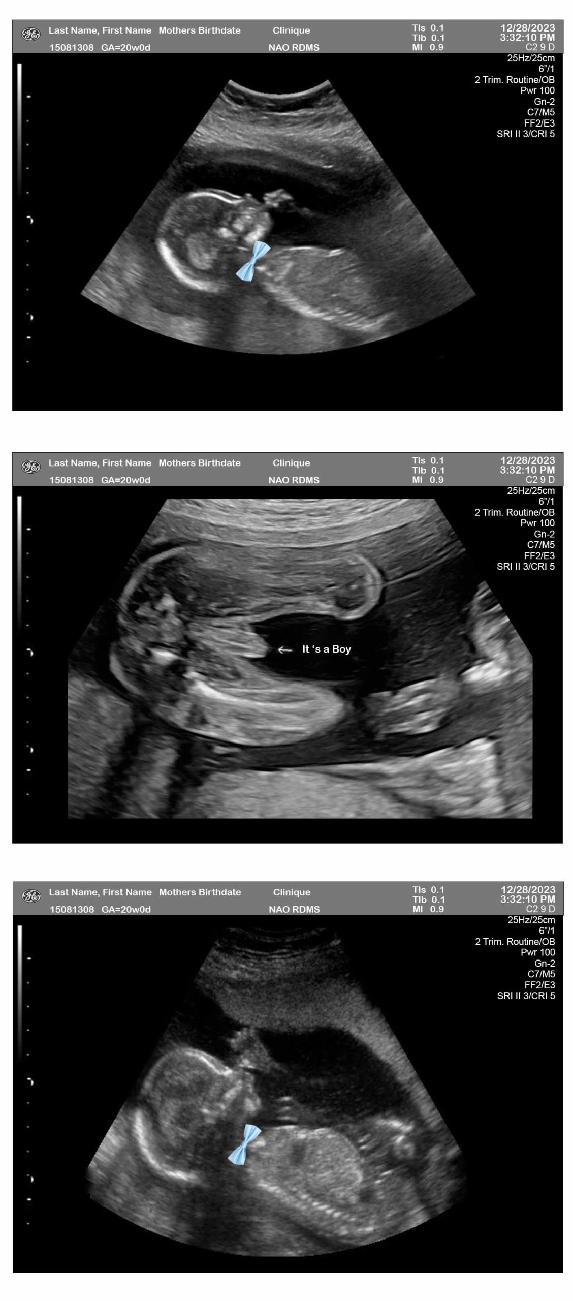 3Fetuses 20 Weeks Ultrasound Boy Bow Tie Ultrasounds